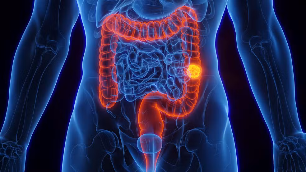 SUS adota novo exame para detectar câncer de intestino antes dos sintomas